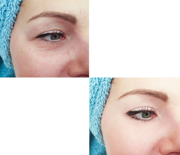 حقن تحت العين – التقنية والنتائج