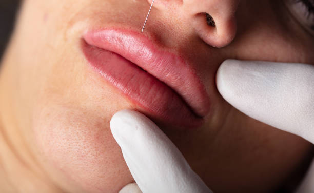 ما هي تقنية توريد الشفاه بالسيستم؟