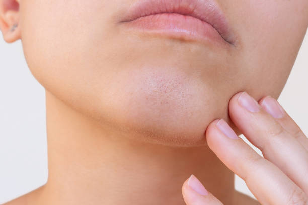 مدة ظهور النتائج بعد العلاج