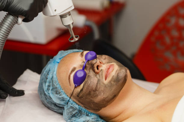 إزالة التصبغات بجلسة واحدة