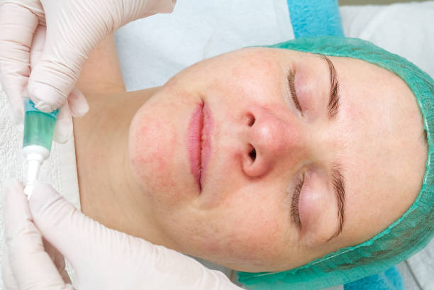 المسام الواسعة والرؤوس السوداء