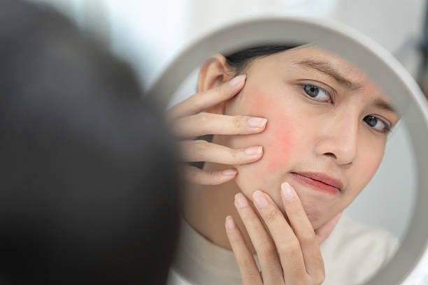 أخطاء تزيد الاحمرار